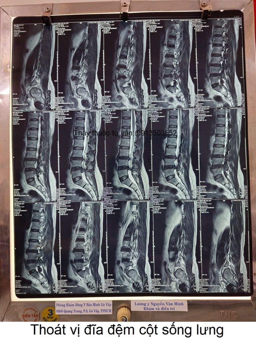 Thoát vị đĩa đệm cột sống lưng